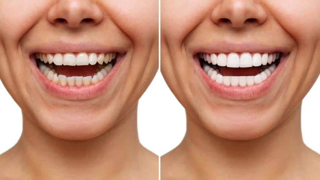 Before and after teeth whitening results. Coventry