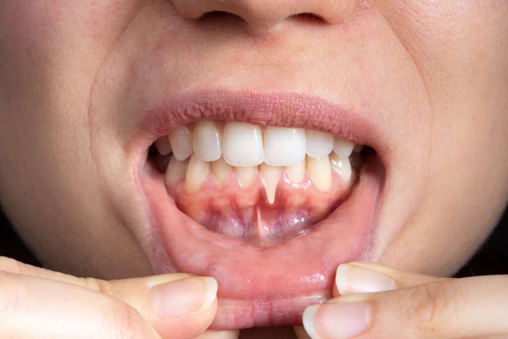 Preparing for teeth whitening with receding gums Coventry